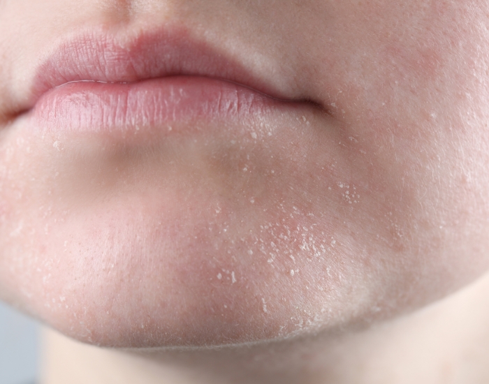 Chronic skin irritation and dry patches