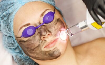 Sunspots and uneven skin tone treated with lasers